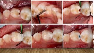 Atraumatic Restorative Technique  ART by Dr Keyura Parakh [upl. by Abijah]