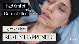 Full Face Dermal Filler 😱 Heres what REALLY happened 2021 [upl. by Mckale793]