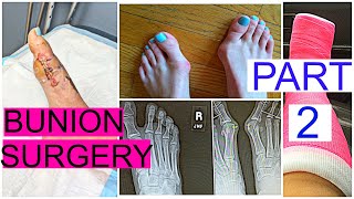 BUNION SURGERY PART 2  STORYTIME  Grace Jennings [upl. by Klimesh]