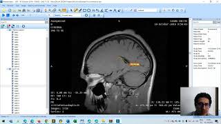 wwwFundacionALorg Visualizar estudios con software wwwmicrodicomcom [upl. by Rahel]