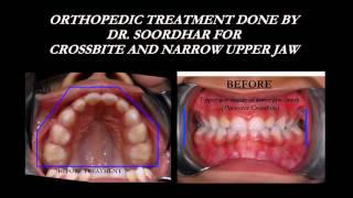 NonExtraction Braces amp Functional Jaw Orthopedics FJOALFPalatal ExpanderFacemaskBioblock [upl. by Jarred]