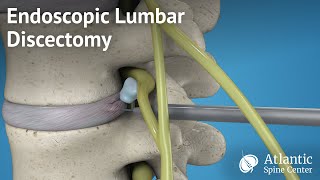 Endoscopic Lumbar Discectomy [upl. by Lledyl]