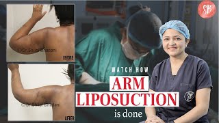 Arm Liposuction Results  Watch Arm Liposuction Full Procedure  Liposuction in Delhi NCR [upl. by Ahsiyn812]