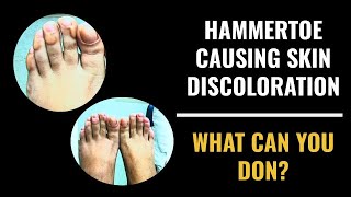 Hammertoe causing skin discoloration  What you can do [upl. by Aiseneg]