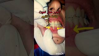 جير اسنان سبب التهاب اللثه وخلخلة الاسنان علاج في عيادة طبيب الاسنان dentist اكسبلور stitch [upl. by Ahsurej]