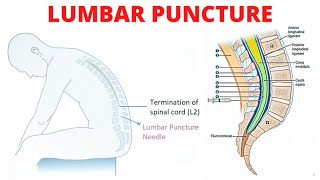 Lumbar Puncture Spinal Tap [upl. by Gnolb437]