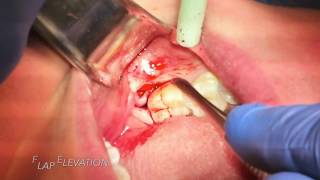 Step by Step Impacted third molar  wisdom tooth  surgical extraction [upl. by Eibbil561]