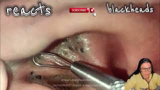 blackhead in ear blackhead in ear removal blackhead in earring hole blackhead in ear extraction [upl. by Wyck]