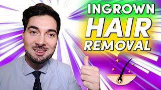 How To Get Rid Of Ingrown Hair Removal and Treatment [upl. by Etteloc947]