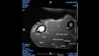 MRI partial rupture radial collateral ligament MCP 1 joint [upl. by Reese]