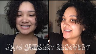 Jaw Surgery Recovery  Day 1  4 weeks [upl. by Ecirtaemed]