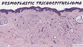 Desmoplastic Trichoepithelioma 5Minute Pathology Pearls [upl. by Adnovay802]