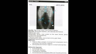 Radiology Achondroplasia [upl. by Begga512]