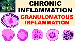 INFLAMMATION Part 9 Chronic Inflammation  GRANULOMATOUS INFLAMMATION [upl. by Eatnahc]