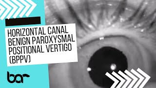 Eye Movements for Horizontal Canal BPPVTDTM episode 2 [upl. by Matty]