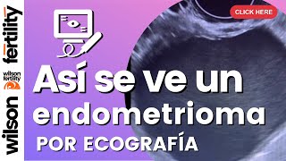 Endometriosis ¿cómo es un endometrioma [upl. by Sabu466]