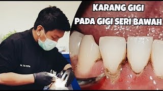 Scaling Pembersihan karang gigi pada gigi seri bawah [upl. by Sotsirhc436]