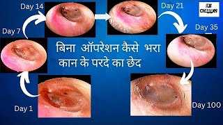 Eardrum perforation healing time । कान का पर्दा फट जाए तो क्या करें [upl. by Anilad561]