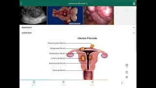 Leiomyoma Fibroids  الورم الليفي العضلي [upl. by Ashbey660]