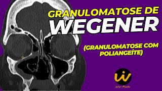 GRANULOMATOSE de WEGENER  Granulomatose com Poliangeíte [upl. by Jasmin444]