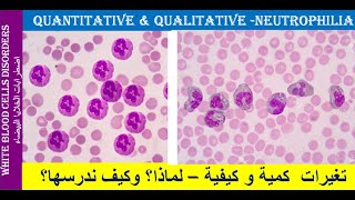 lecture 22 Neutrophilia Quantitative and Qualitative Changes [upl. by Liuqa248]