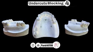 Undercuts Blocking To Preparation Removable Partial Denture  LAB4 [upl. by Dielle688]