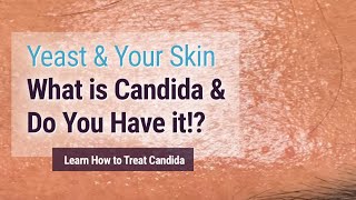 Yeast affecting your skin You may have it and not know Candida Albicans [upl. by Slayton173]