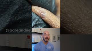 Derm reacts to super satisfying ingrown hairs ingrownhair satisfying [upl. by Anaeda917]