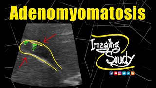 Adenomyomatosis of Gallbladder  Ultrasound  Case 198 [upl. by Kielty]