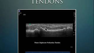 MSK Ultrasound tendon joints [upl. by Nets]