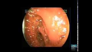 ERCP with BalloonAssisted Enteroscope in Patients with Surgically Altered Upper GI Anatomy [upl. by Yenmor]