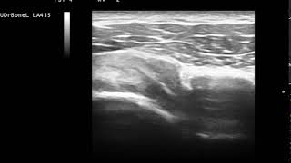 洪辰宇醫師 肩關節喙突下夾擠症候群 超音波動態檢查  Subcoracoid impingement dynamic US examination [upl. by Tracy]