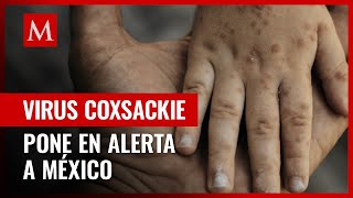 Qué es el coxsackie y cómo se contagia la enfermedad que tiene en alerta a México [upl. by Musser]