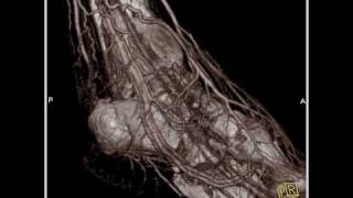 Vascular CT angiography of the lower extremity3 of 3 [upl. by Yorgo]