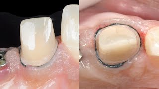 Dental basics Gingival Retraction  The two cord technique [upl. by Belter700]