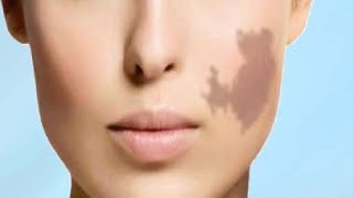 how to get rid of birthmarks on your face naturally [upl. by Letha]