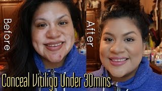 HOW TO Conceal Vitiligo under 30mins Full Face amp Drugstore Products [upl. by Joslyn]