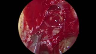 Full Functional Endoscopic Sinus Surgery FESS for sinusitis [upl. by Retrak]