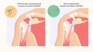 Two common types of biceps tenodesis yield comparable outcomes at midterm followup [upl. by Cerveny]