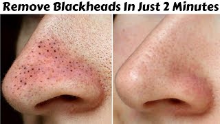 Remove Blackheads amp Whiteheads in Just 2 Minutes  Best Easy amp 100 Effective Home Remedy [upl. by Neitsirk]