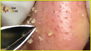 Best Satisfying Nose Plucking Blackheads Whiteheads Removal  Acne Treatment 30 [upl. by Claudie417]