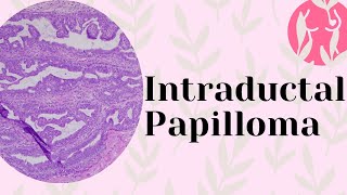 Intraductal Papilloma pathology [upl. by Aaberg248]