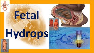 Fetal Hydrops  Hydrops Fetalis  Fetal Hydrops Causes Complications Treatment and Prognosis [upl. by Eolande]