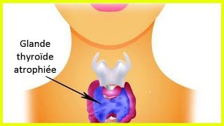 L’hypothyroïdie  comment prendre soin de sa thyroïde [upl. by Ynnavoig85]