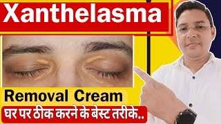 Xanthelasma Removal Cream  How to treat Xanthelasma home Remedies [upl. by Esimaj804]