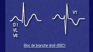 ECG Normal partie 3 [upl. by Queridas]