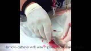 Placing a jugular catheter [upl. by Gamaliel]