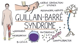 Guillain barre syndrome  GBS [upl. by Anivek510]