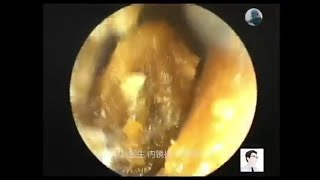 Clearance of external ear canal earwax and external auditory canal cholesteatoma for 14 minutes [upl. by Trescha]