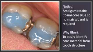 Dentistry  Core build up for crowns done in a unique way [upl. by Olga]